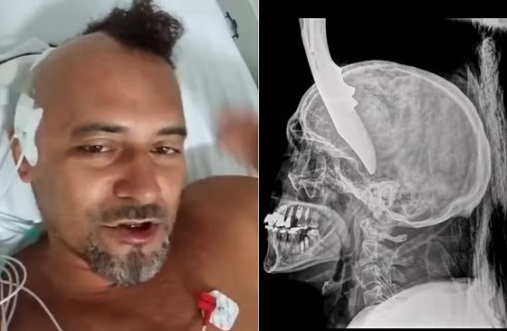 Homem e raio-X craniano lado a lado.jpg